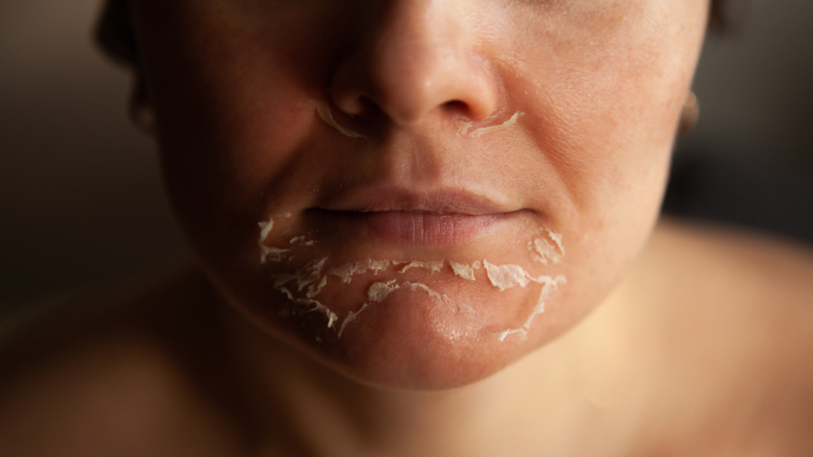 pele do rosto descascando: causas e tratamentos