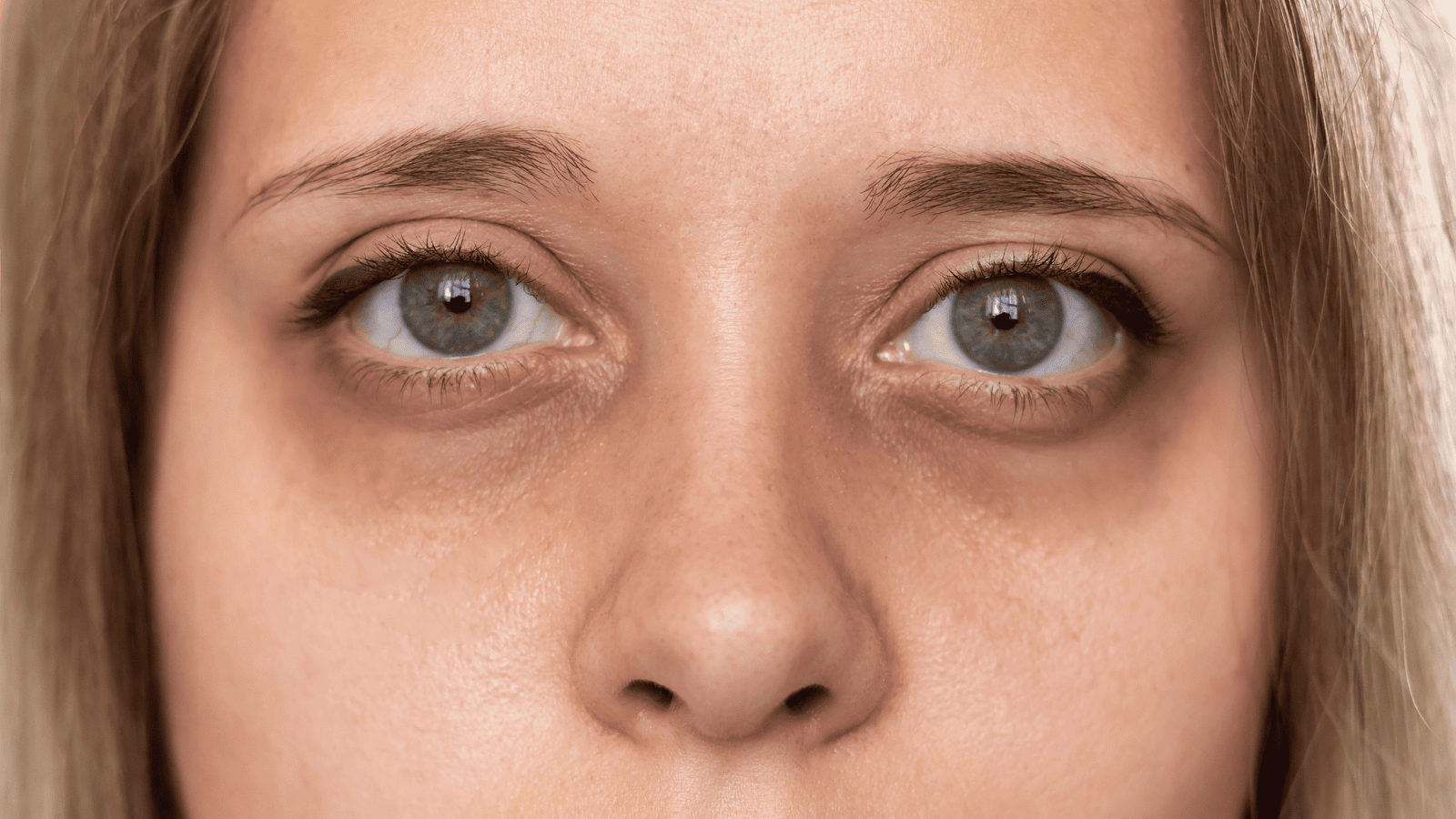 4 tipos de olheira e suas causas